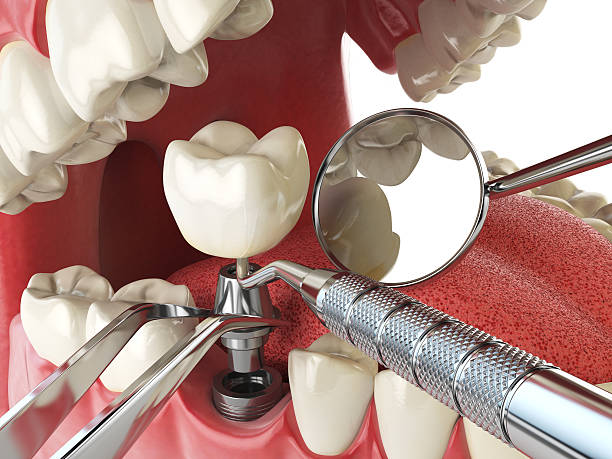 Best Emergency Dentist for Lost Fillings or Crowns in Vernon Hls, IL